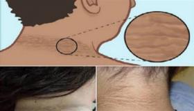 ظهور بقعة مخملية داكنة على الرقبة تحذير لمقاومة الأنسولين